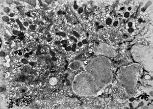 F,3m. | giant cell hepatitis - cholestasis